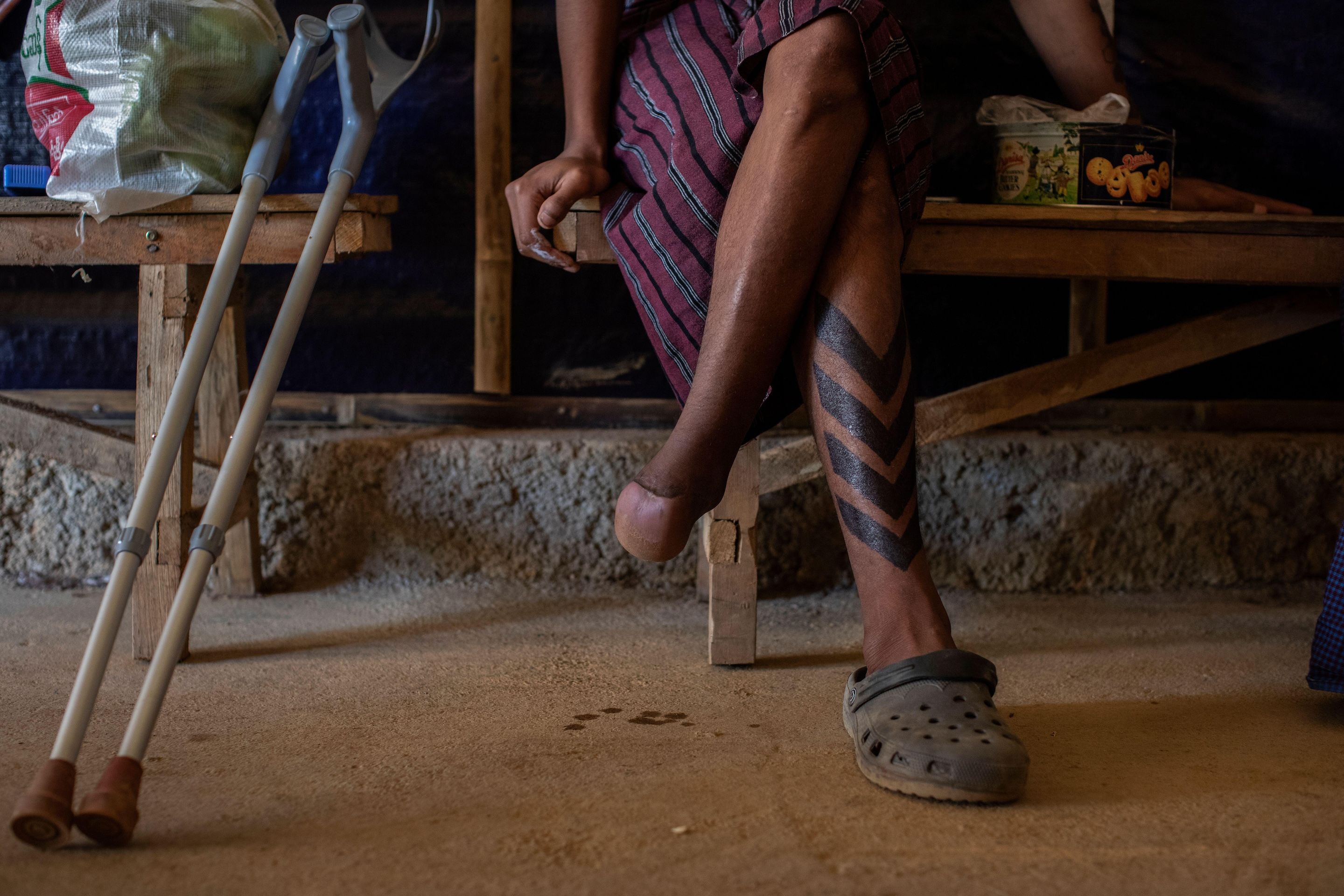 A man sits with legs crossed, showing a severely damaged foot, with all toes missing.